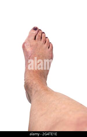 Hallux valgus, Boignon sur le pied de la femme âgée isolé sur fond blanc. Déformation douloureuse de l'articulation de l'orteil avec un mauvais alignement de l'orteil. Diagnostic orthopédique. Banque D'Images