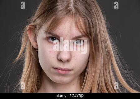 Le visage d'une adolescente avec des boutons gros plan sur un fond gris. Banque D'Images