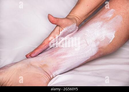 Le traitement traditionnel pour les allergies. La main d'une femme met une crème cicatrisante sur sa jambe avec une dermatite et une réaction allergique. Allergie grave, irrita Banque D'Images
