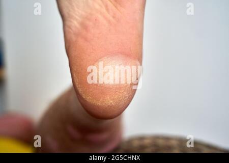 Gros plan d'une grande plaquette thermoformée sur le talon d'un pied Banque D'Images