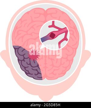 Types d'illustration de vecteur d'AVC cérébral humain | infarctus cérébral Illustration de Vecteur