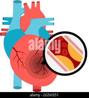 Anatomie cardiaque humaine avec crise cardiaque. Plaque athérosclérotique dans les vaisseaux sanguins. Illustration de Vecteur