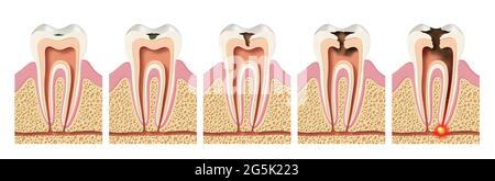 Étapes de développement des caries. Parodontite Banque D'Images