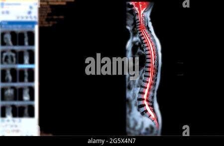 IRM du plan sagittal T2W de la colonne vertébrale entière pour la compression diagnostique de la moelle épinière. Banque D'Images