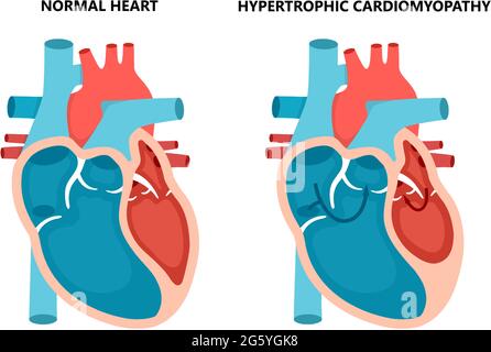 Cardiomyopathie hypertrophique avec vue en coupe. Maladies du muscle cardiaque humain. Concept de cardiologie. Illustration de Vecteur