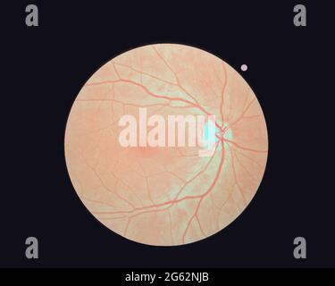 Image rétinienne de l'œil gauche isolée sur un fond noir. Une rétine humaine normale. Banque D'Images