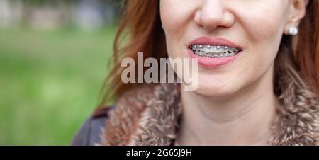 Le sourire d'une jeune fille avec des bretelles sur ses dents blanches. Redressage des dents. Malocclusion. Soins dentaires. Banque D'Images