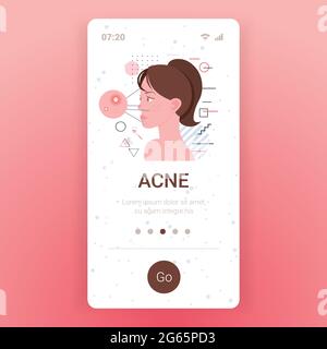 acné sur la femme visage pore comedones cosmétologie problèmes de soin de la peau traitement maladie de peau concept smartphone écran mobile app portrait Illustration de Vecteur