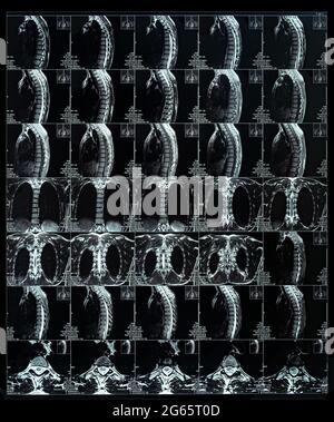 Les rayons X du film de scoliose montrent une courbure de la colonne vertébrale dans l'image de la colonne thoracique Banque D'Images