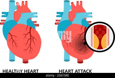 Coeur sain et malsain. Coeur avec plaque athérosclérotique. Illustration de Vecteur