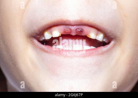 Un garçon de 5 ans dont l'incisive supérieure de la dent de lait est tombée. Patient enfant, bouche ouverte montrant des caries, carie dentaire. Banque D'Images