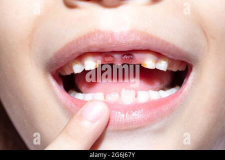 Un garçon de 5 ans dont l'incisive supérieure de la dent de lait est tombée. Patient enfant, bouche ouverte montrant des caries, carie dentaire. Banque D'Images