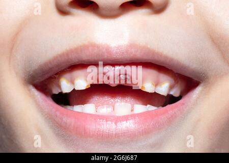 Un garçon de 5 ans dont l'incisive supérieure de la dent de lait est tombée. Patient enfant, bouche ouverte montrant des caries, carie dentaire. Banque D'Images