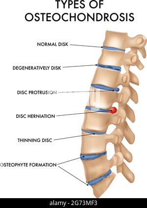 Segment de colonne vertébrale hernie intervertébrale vertébrale ostéochondrose carte de pathologie réaliste de l'éducation médicale anatomie Livre poster vecteur illu Illustration de Vecteur