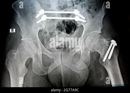 Rayon X simple avec une fracture pelvienne qui est fixé avec 4 vis et 2 tiges et fracture du grand trochanter du fémur fixé avec 2 vis Banque D'Images