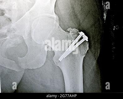 rayon x simple sur la hanche gauche joint avec une fracture du grand trochanter du fémur fixé avec 2 vis dans une opération de réduction ouverte Banque D'Images