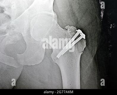 rayon x simple sur la hanche gauche joint avec une fracture du grand trochanter du fémur fixé avec 2 vis dans une opération de réduction ouverte Banque D'Images