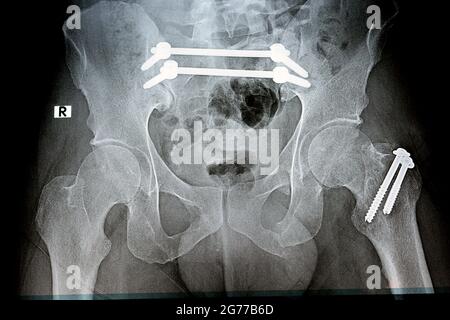 Rayon X simple avec une fracture pelvienne qui est fixé avec 4 vis et 2 tiges et fracture du grand trochanter du fémur fixé avec 2 vis Banque D'Images