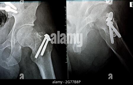 rayon x simple sur la hanche gauche joint avec une fracture du grand trochanter du fémur fixé avec 2 vis dans une opération de réduction ouverte Banque D'Images