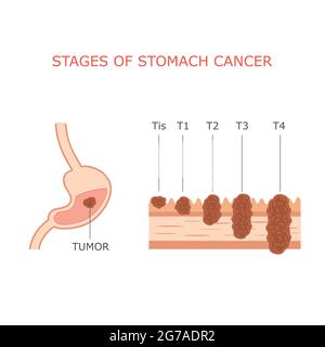 stades du cancer de l'estomac, anatomie de la tumeur gastrique humaine, système digestif Illustration de Vecteur