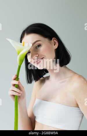 Femme souriante avec vitiligo tenant cala lys isolé sur gris Banque D'Images