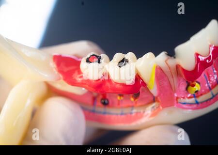 Pourriture dentaire dentistes modèle dentaire des dents, des gencives et du canal racinaire Banque D'Images