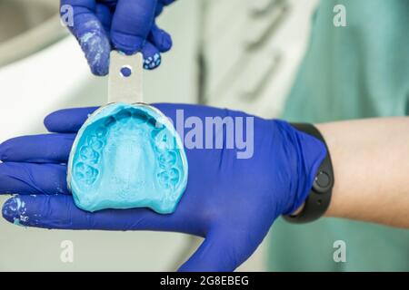 mains avec des gants en latex bleu tenant le moule métallique avec alginate bleu avec impression dentaire Banque D'Images