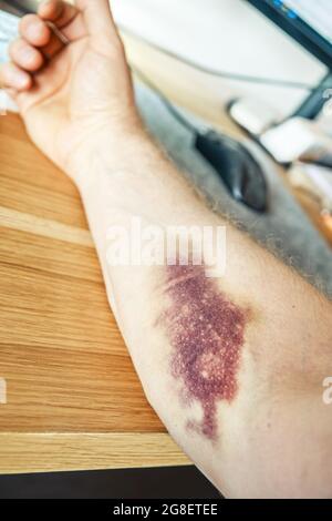 Le jeune homme montre une grande ecchymose pourpre suite à l'injection de la veine sur l'avant-bras assis à une table en bois dans la salle lumineuse vue très rapprochée Banque D'Images