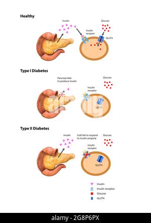 Action de l'insuline et diabète de type 1 et 2, graphique 2d 3d, rendu, illustration Banque D'Images