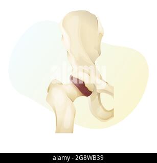 Arthrose - mort osseuse - articulation de la hanche - Illustration de stock comme fichier EPS 10 Illustration de Vecteur