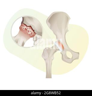 Arthrose - mort osseuse - articulation de la hanche - Illustration de stock comme fichier EPS 10 Illustration de Vecteur