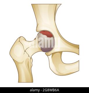 Arthrose - mort osseuse - articulation de la hanche - Illustration de stock comme fichier EPS 10 Illustration de Vecteur