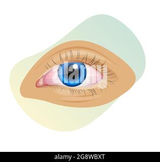 Infection fongique dans l'oeil Irritant - oeil rose - icône comme fichier EPS 10 Illustration de Vecteur