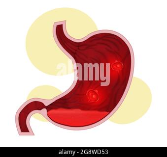 Ulcère peptique - mal d'estomac - Illustration comme fichier EPS 10 Illustration de Vecteur