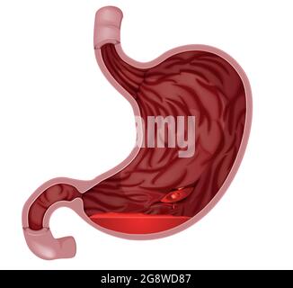 Ulcère peptique - mal d'estomac - Illustration comme fichier EPS 10 Illustration de Vecteur