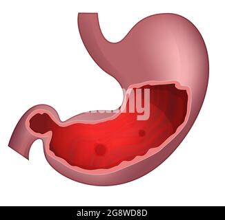Ulcère peptique - mal d'estomac - Illustration comme fichier EPS 10 Illustration de Vecteur