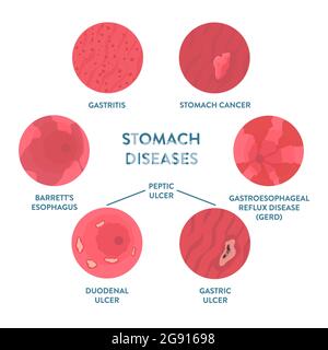 Maladies de l'estomac, illustration Banque D'Images