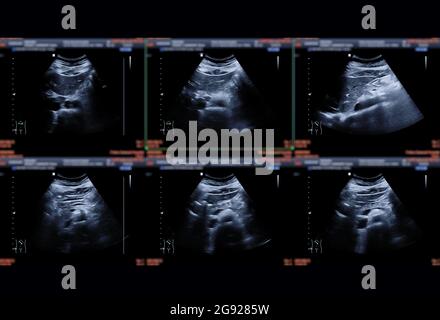 Échographie abdomen supérieur montrant le foie, les reins, la pancréase et la vésicule biliaire pour détecter HCC ou pierre de Gall. Banque D'Images