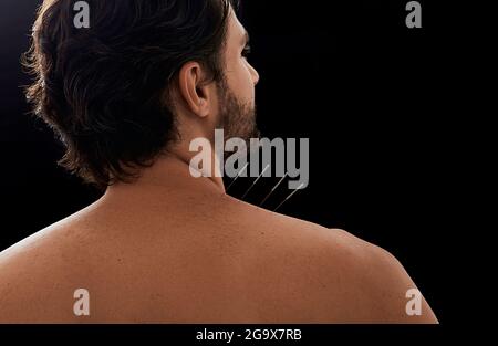 Acupuncture, réflexologie. Vue rapprochée du dos du patient mâle avec aiguilles d'acupuncture dans son épaule avec douleur, sur fond noir Banque D'Images