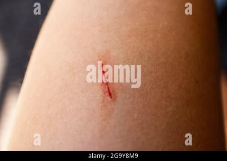 Plaie fraîche sur la jambe, la cuisse avec du sang. Texture de la peau. Corps positif - cheveux. Jambe de femme. La rayure rouge est en train de saigner. Premiers soins. Gros plan. Banque D'Images