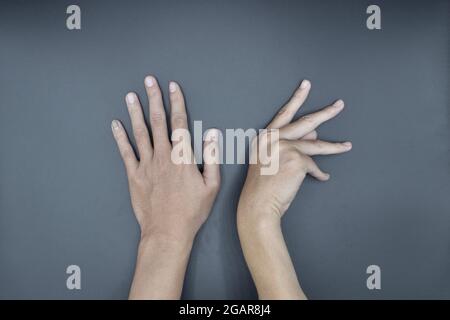 La contraction unilatérale de Dupuytren chez le jeune homme asiatique. Difformité unilatérale de la main. Flexion anormale des doigts. Isolé sur fond gris. Banque D'Images