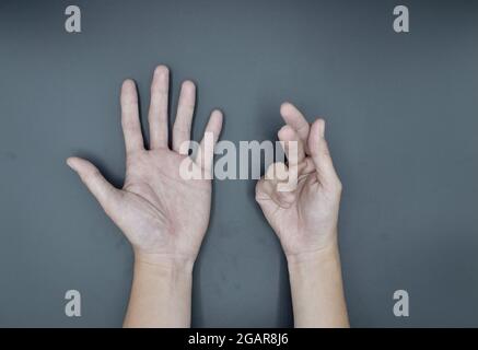 La contraction unilatérale de Dupuytren chez le jeune homme asiatique. Difformité unilatérale de la main. Flexion anormale des doigts. Isolé sur fond gris. Banque D'Images