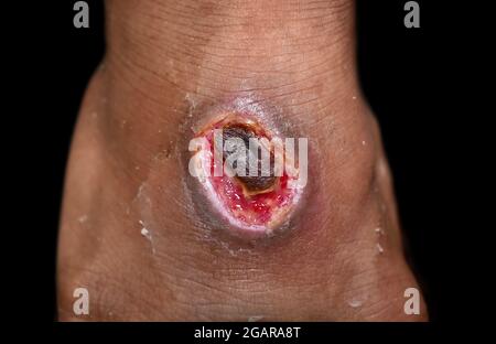Ulcère chronique ou blessure sur le dorsum du pied en Asie du Sud-est, birman, adulte de sexe masculin. Isolé sur fond noir. Banque D'Images
