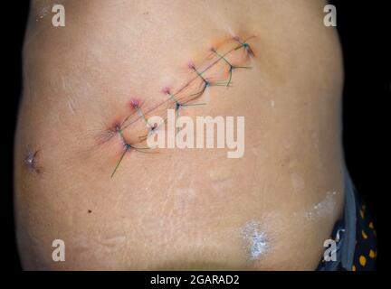 Incision de Kocher ou incision sous-costal ou oblique pour une cholécystectomie ouverte. Plaies ou points de suture infectés. Il est également fait pour la chirurgie du foie et de la bili Banque D'Images