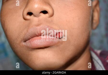 Petite blessure lacérée dans la lèvre de l'asiatique, enfant. Vue en gros plan. Banque D'Images