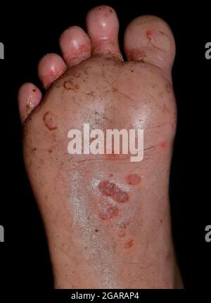 Infestation de gale avec infection secondaire ou fongique ou tinea pedis au pied de l'homme d'Asie du Sud-est. Isolé sur fond noir Banque D'Images