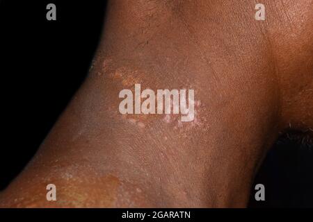 Tinea versicolor ou pityriasis alba dans le cou de l'homme d'Asie du Sud-est. Isolé sur le noir. Banque D'Images