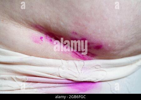 Coutures chirurgicales, suture au niveau de l'abdomen. Une blessure sur l'abdomen d'une personne. Lésion cutanée traitée avec une onguent antiseptique et médicinal. Banque D'Images