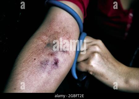 Le bras de la femme est meurtri par la prise de narcotiques intraveineux. La femme toxicomanes tire la main avec le tourniquet. Hémogramme en gros plan. Concept de désespoir et de dépression. Dépendance à des substances illégales. Banque D'Images