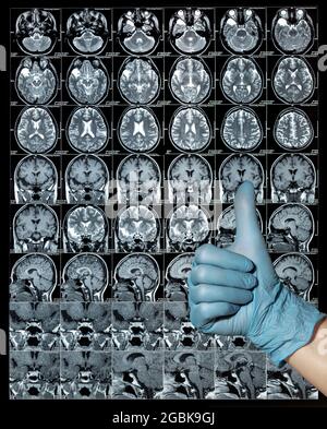 Résultats de l'IRM du cerveau ou de l'image par résonance magnétique, concept de neurologie, pouces vers le haut Banque D'Images